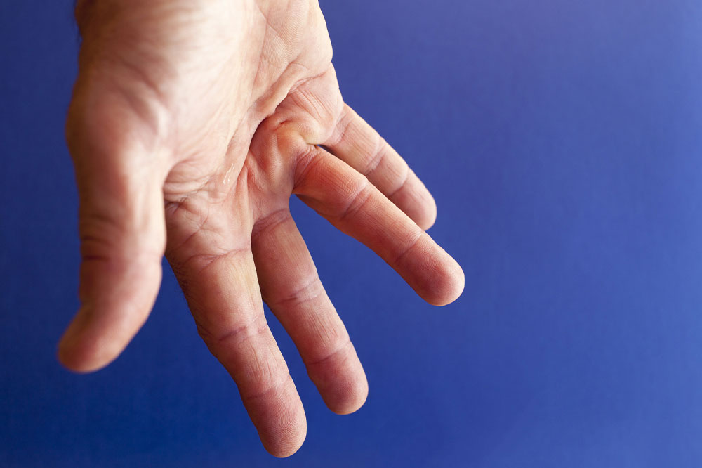 Dupuytren’s Contracture – Causes, Symptoms, and Home Remedies