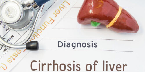 Liver Cirrhosis – Its Stages and Prevention