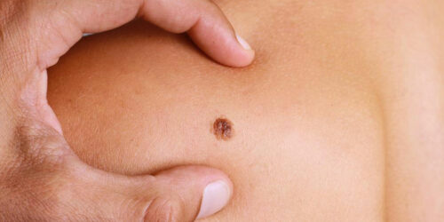 4 common types of melanoma and their treatment options