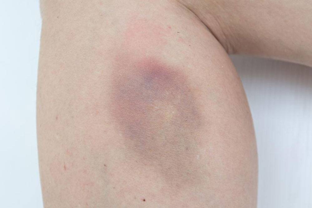 Easy bruising – Causes and treatments