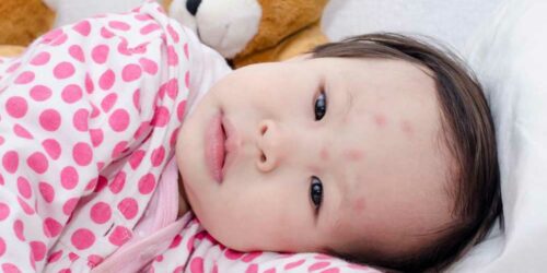 Here’s How to Identify Common Insect Bites