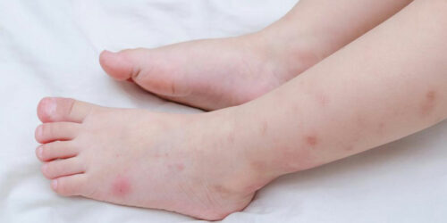 Here’s how to identify insect bites quickly