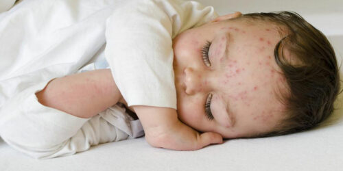 Here’s how to treat skin rashes in babies