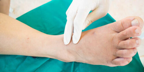 Here’s what you need to know about neuropathy symptoms and more