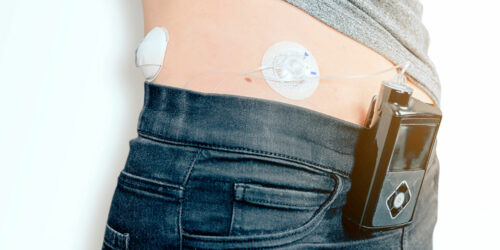 Insulin pumps – 3 best devices to buy in 2021