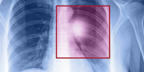 Lung cancer – Types, symptoms, and causes