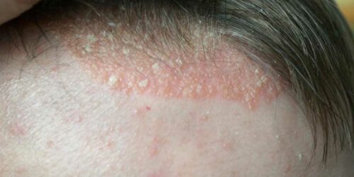 Scalp Psoriasis – Symptoms to Watch out For