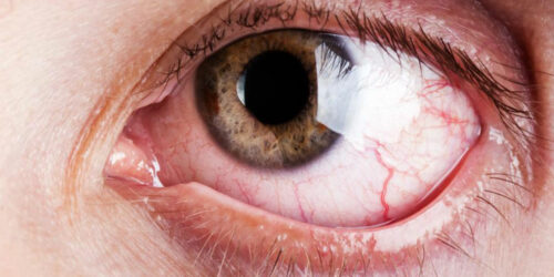 What are the common and rare symptoms of Graves’ disease