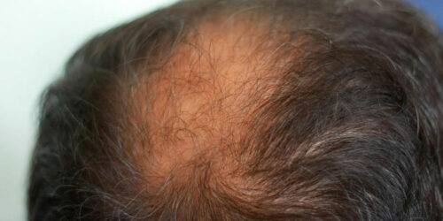 8 Effective Home Remedies for Thinning Hair