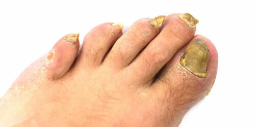 An Effective Way to Treat Toenail Fungus – Hydrogen Peroxide