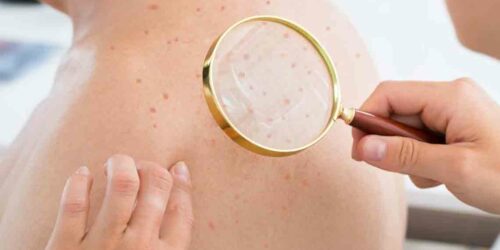 Atopic Dermatitis Eczema – Causes, Symptoms, and Treatments