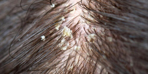 Get Rid of Dry Scalp with Nature’s Care