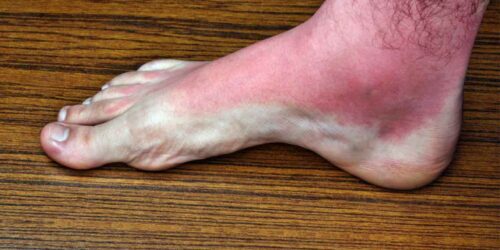 Heat rash: Causes, symptoms, and treatment