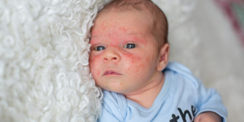 Know the Causes, Symptoms, and Treatments of Eczema