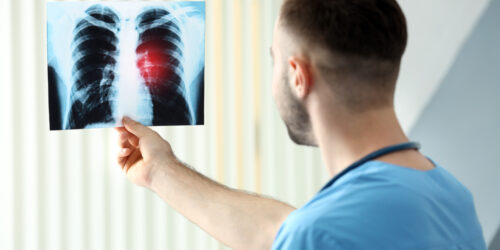 Lung Cancer – Risk Factors, Diagnosis, Symptoms, And Treatment