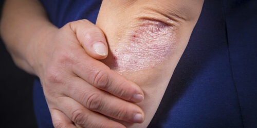 Symptoms and risk factors of psoriasis
