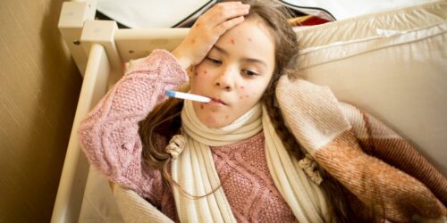 Things You Need to Know about Measles