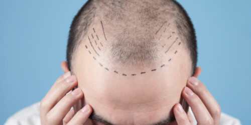 Hair Transplant – Techniques, Costs, and More