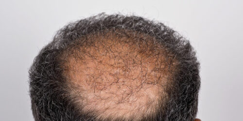 Hair Transplant – Types, Procedure, and Cost